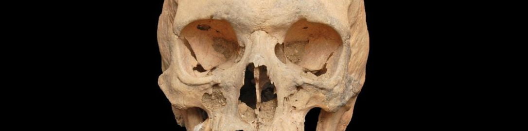 Ancient skull of 35-year-old man with fused jaws